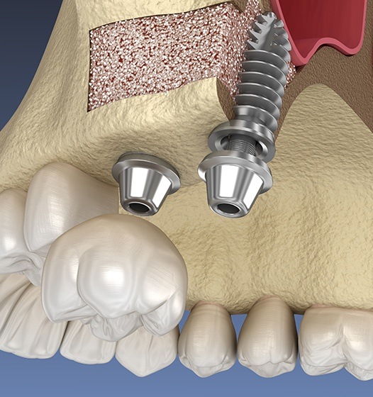 Aniamted smile with dental implant placed in grafted bone tissue