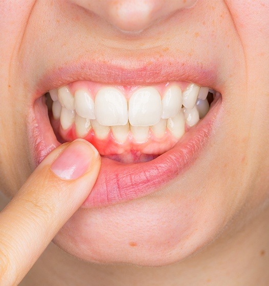 Patient with gum recession pointing to her smile
