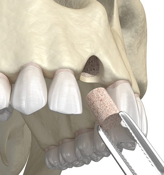 Animated smile during bone grafting