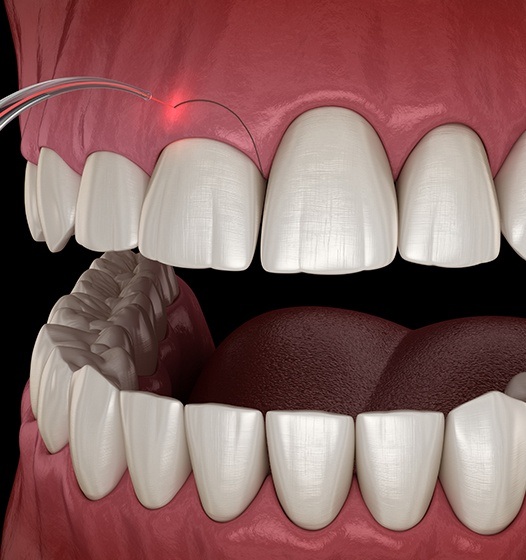 Animated smile during crown lengthening treatment