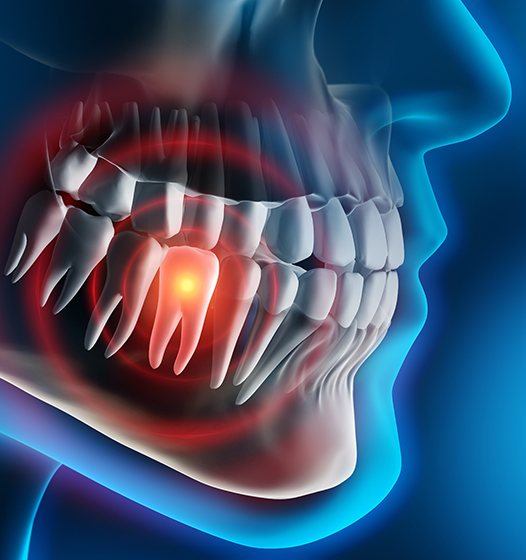 3 D animated smile with tooth in need of extraction highlighted red