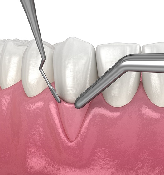 Animated smile during gum grafting treatment