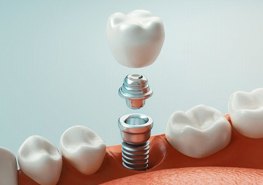 dental implant being placed in the lower jaw