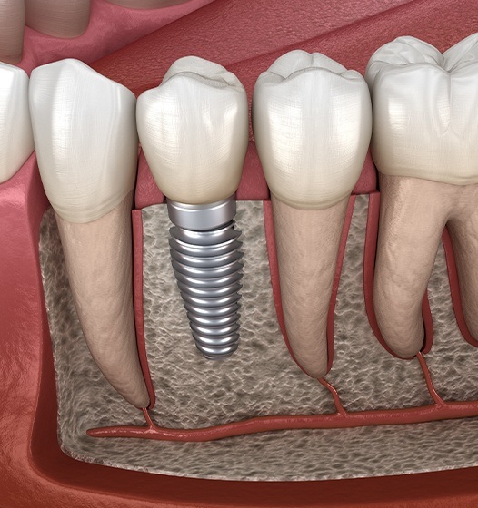 Animated smile with dental implant supported replacement tooth