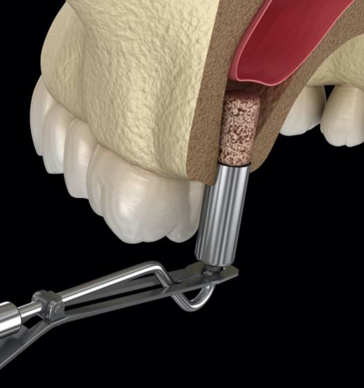 Animated smile during bone grafting procedure