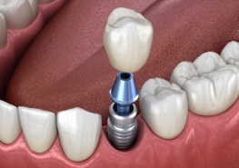 Animated dental implant supported dental crown placement