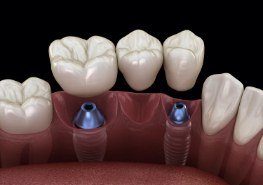 Animated dental implant supported fixed bridge placement