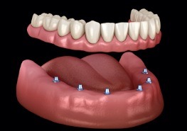 Animated dental implant supported denture placement