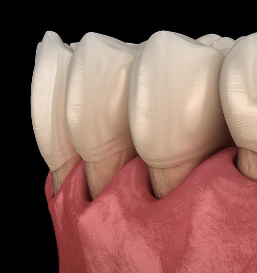 Animated smile with receding gums and early sign of gum disease