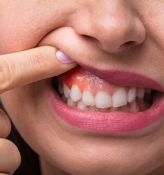 Closeup of smile with red infected gums in need of advanced periodontal care