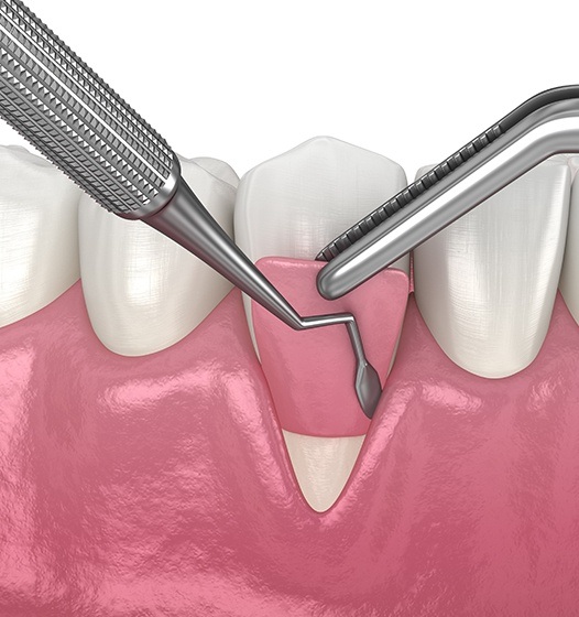 Animated smile during gum grafting treatment