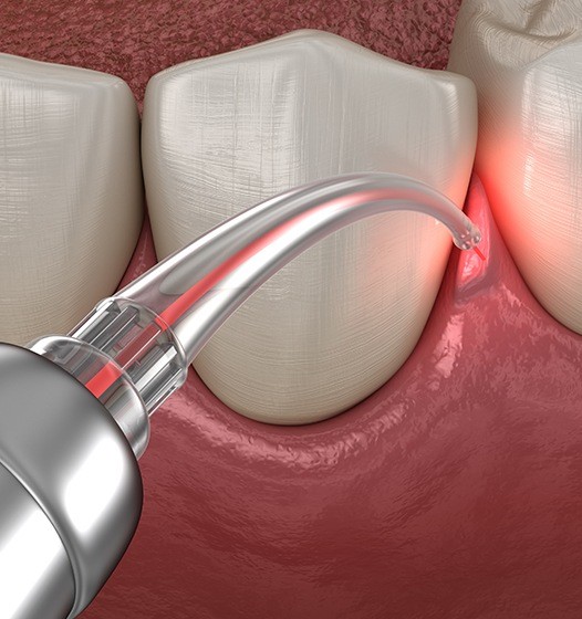 Animated smile during LANAP treatment