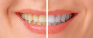 If you’re in search of teeth whitening in Fremont from a qualified, experienced dentist, Dr. Joe Provines at Peninsula Center for Implantology is the dentist you need. 