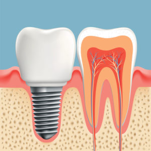 Get a complete smile with dental implants in Sunnyvale.