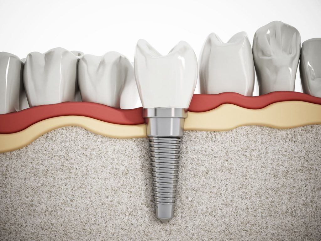 Choose a Periodontist in Sunnyvale for Dental Implants