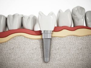 Treat your tooth loss with your periodontist in Sunnyvale.