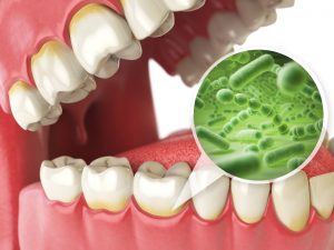 Model showing signs of gum disease